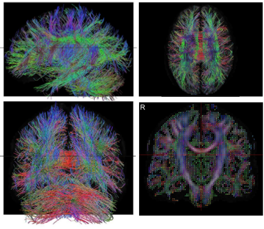 Research Whole Brain Tractography.png