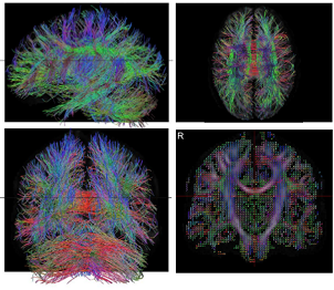 Research Whole Brain Tractography.png