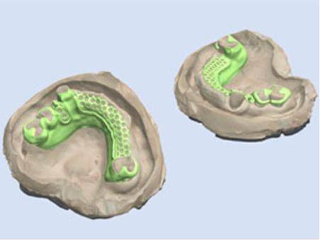 3D Printing Used for Surgery Planning