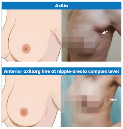 Minimally Invasive Breast Surgery: Smaller and hidden incisions allow for faster recovery and better cosmesis - CGH