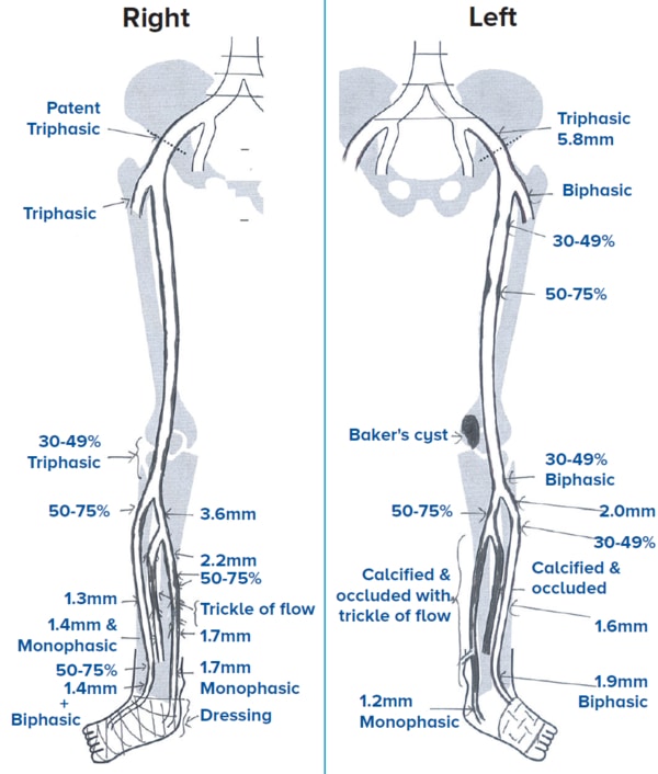 angiographic images right and left legs - SingHealth Duke-NUS Vascular Centre