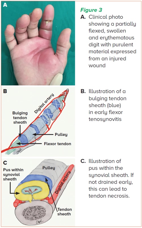 Flexor tenosynovitis - SGH