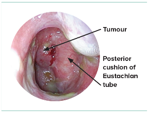 Tumour in the post-nasal space - SingHealth Duke-NUS Head & Neck Centre