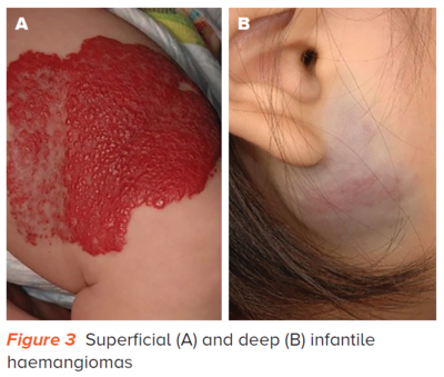 Infantile haemangiomas - SingHealth Duke-NUS Vascular Centre