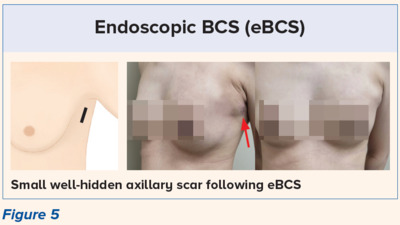 Endoscopic BCS Volume Displacement and Volume Reduction oBCS Techniques - SingHealth Duke-NUS Breast Centre