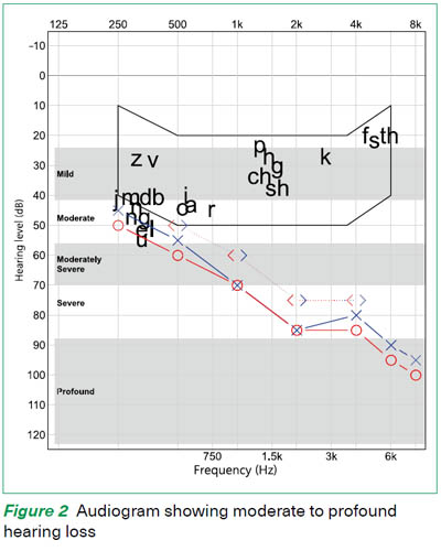 Hearing loss audiogram - Singapore General Hospital;