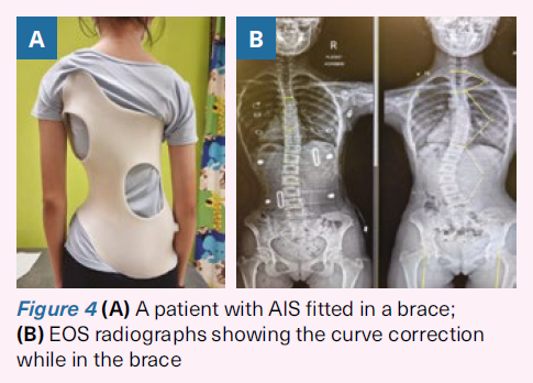 Bracing correction for AIS - SingHealth Duke-NUS Spine Centre