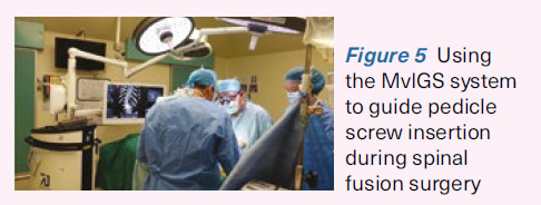 MvIGS system to guide pedicle screw insertion during spinal fusion surgery - SingHealth Duke-NUS Spine Centre