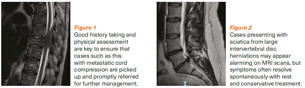 Sciatica interventions - SingHealth Duke-NUS Spine Centre 