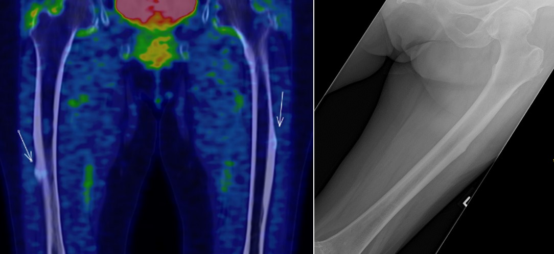 18F-FDG PET/CT images demonstrating cortical thickening in the bilateral femoral mid-shafts - SGH