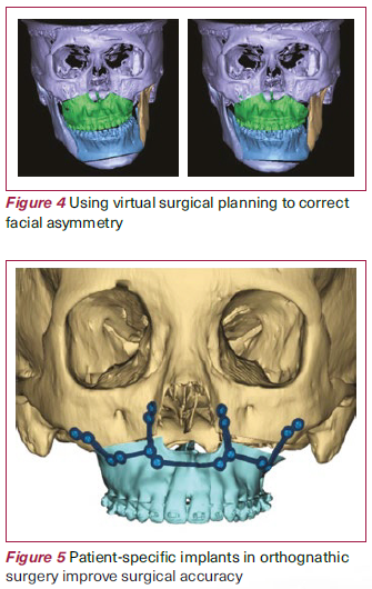 Virtual surgical planning and patient-specific implants in orthognathic surgery - NDCS