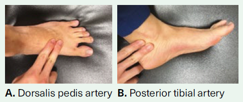 Location of pedal pulses - SingHealth Duke-NUS Vascular Centre