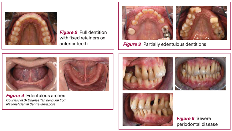Patient selection for MAD - NDCS