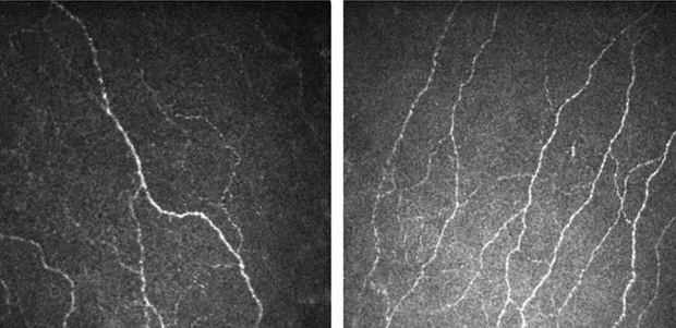  ​A patient's corneal nerves that were damaged due to diabetes (left) became healthier and increased in number with Fenofibrate, a lipid-lowering drug. PHOTO SINGAPORE NATIONAL EYE CENTRE