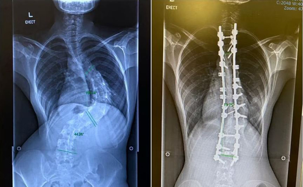  ​To correct severe scoliosis (left), Ms Natasha Ramli had to have two titanium rods and 20 screws implanted in her back (right). PHOTOS NATASHA RAMLI 