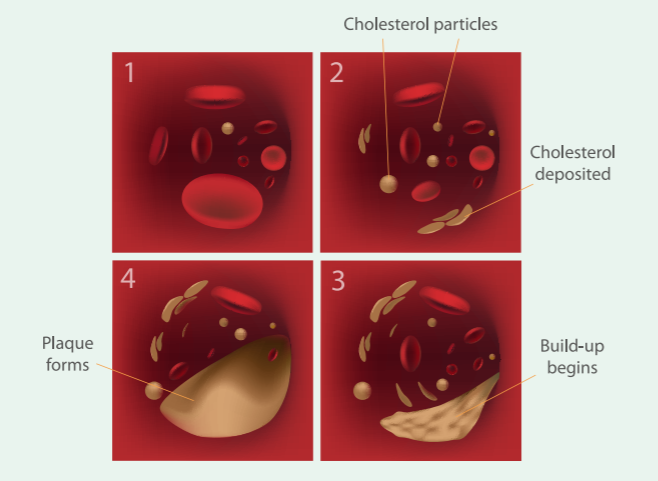 atherosclerosis