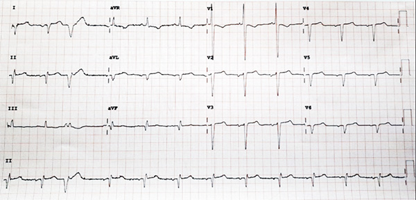 ECG Dextrocardia