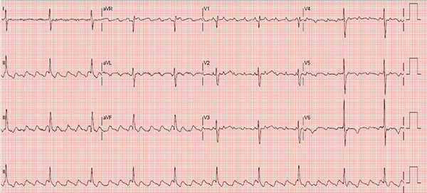 ECG Atrial Flutter