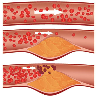 Plaque rupture in a heart attack | SingHealth