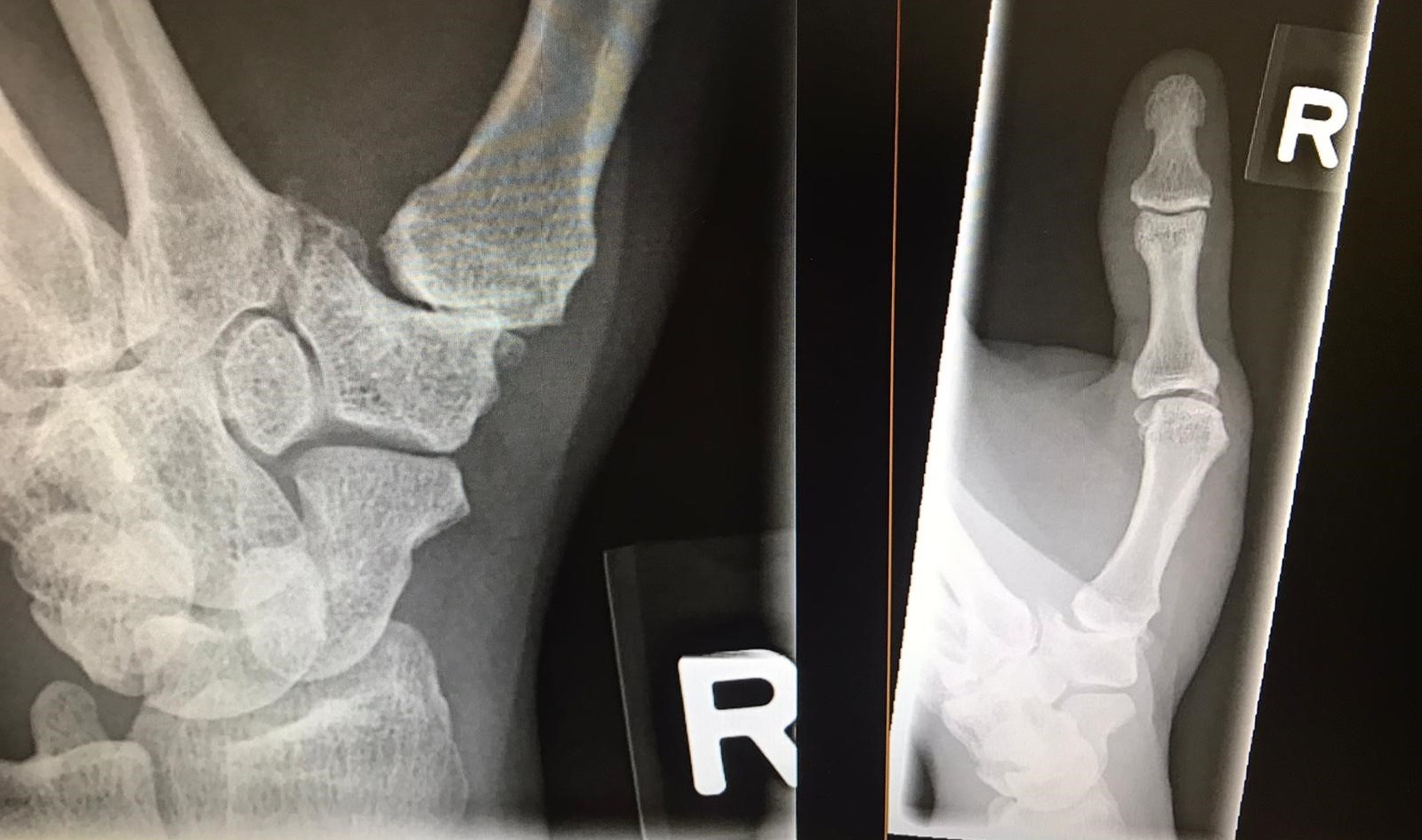 1st CMC Arthroplasty