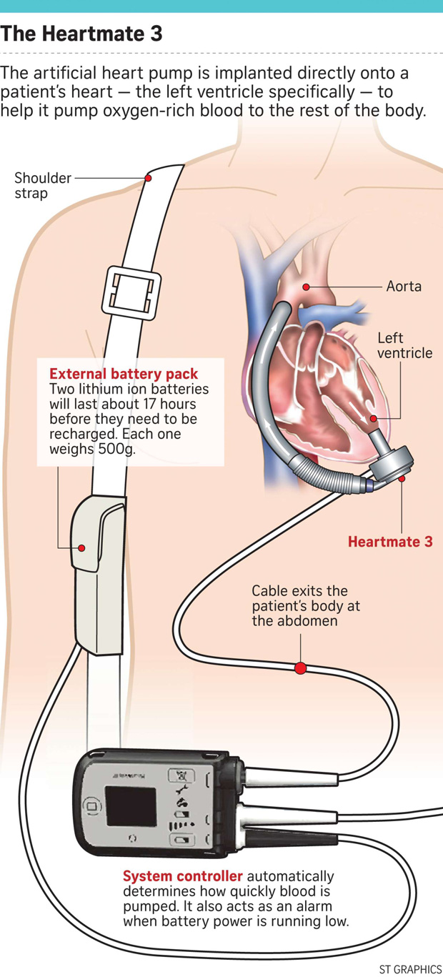 ​1st Asian to get new heart pump in NHCS
