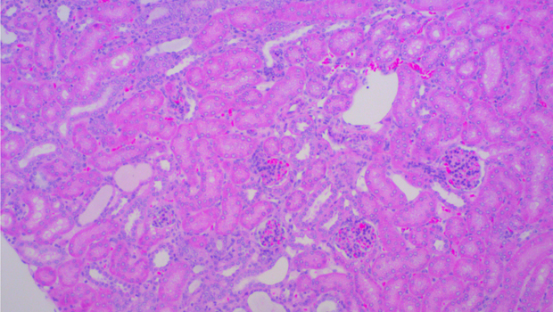  ​Section of a diseased kidney treated with a drug preventing Wnt secretion