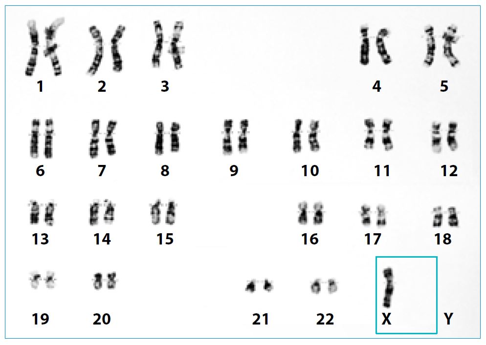 Karyotype showing classic Turner syndrome