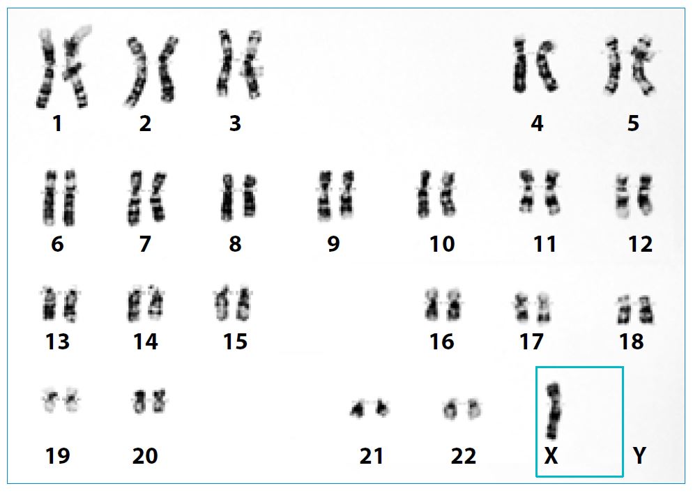 Karyotype showing classic Turner syndrome | SingHealth