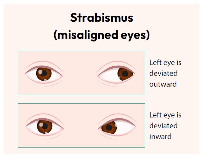 Strabismus (misaligned eyes)