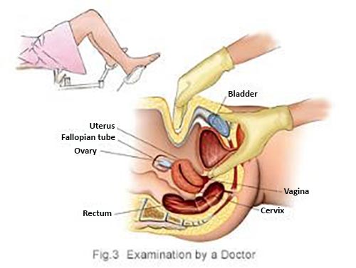 pelvic examination for ovarian cancer