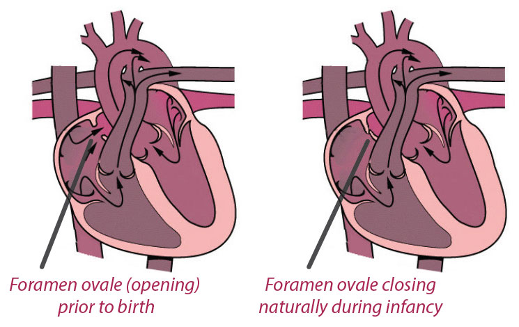 Patent foramen ovale