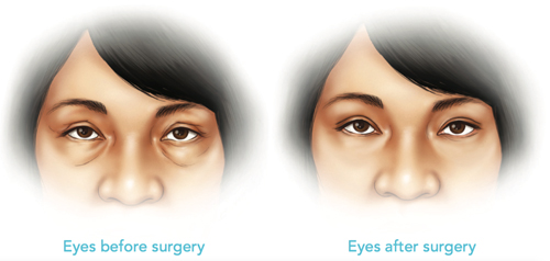 before and after aesthetic eyelid surgery (blepharoplasty)