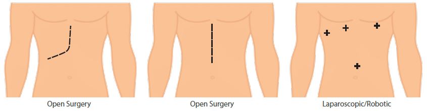 Liver Resection