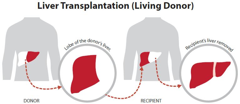 Liver Transplant