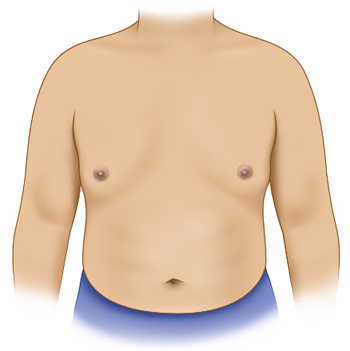 Gynaecomastia surgery - Male chest after surgery 