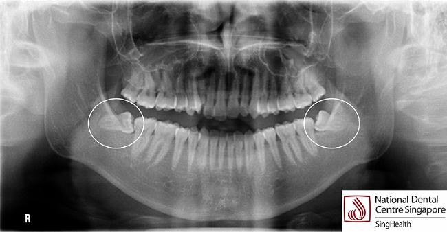 Wisdom Tooth Surgery resized.png