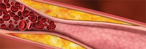 Coronary Artery Disease | SingHealth