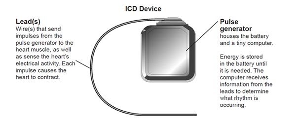 implantable cardioverter defibrillator