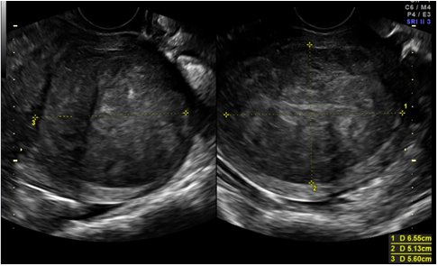 Uterine Fibroids