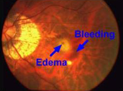 Myopic Maculopathy Highly Myopic