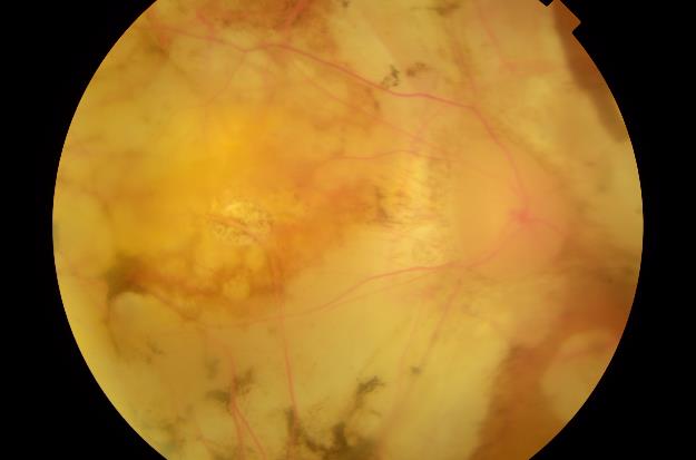 Myopic Maculopathy - Highly Severe Degeneration