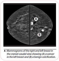 breast cancer diagnosis mammogram