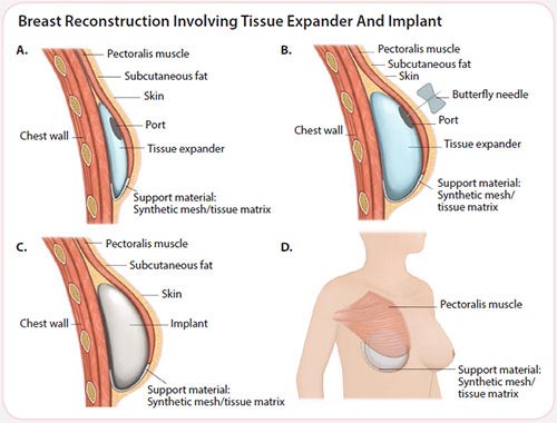 breast cancer treatment - breast reconstruction
