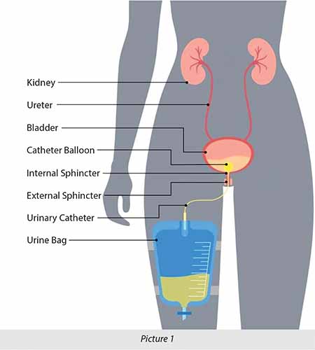 urinary catheter