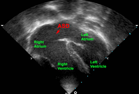 atrial-septal-defect-diagnosis at KKH