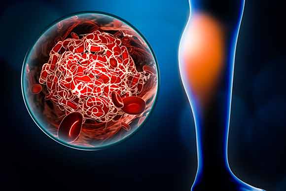 deep vein thrombosis conditions & treatments