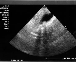 diagnosis of gallstones