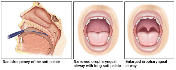 Palatal surgery to treat OSA - SingHealth Duke-NUS Sleep Centre