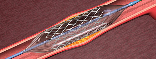 illustration heart stent