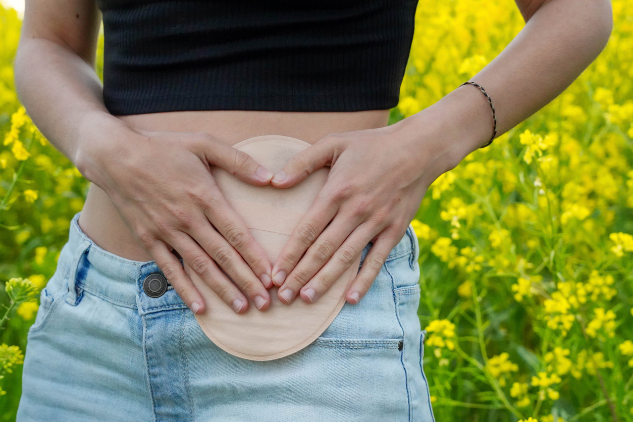  woman with stoma bag | SingHealth